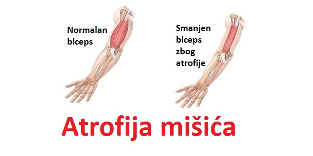Atrofija mišića noge ili ruke kod dece i odraslih - simptomi, uzroci i lečenje