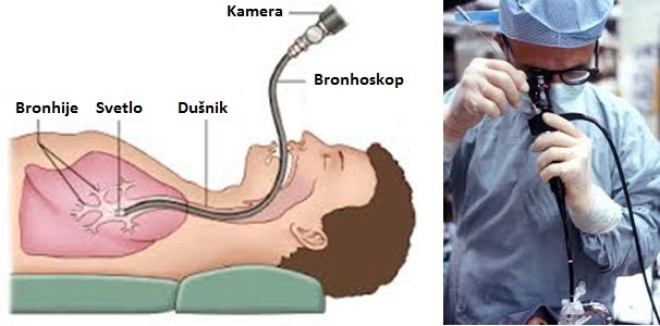 bronhoskopija-proces-nalaz-rezultati-iskustva-i-cena