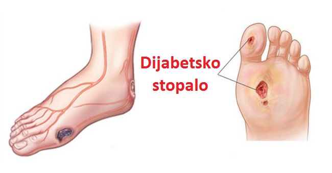 dijabeticko-stopalo-simptomi-uzrok-i-lecenje