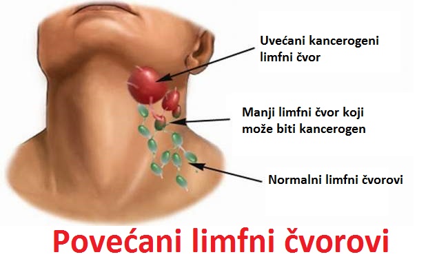 Povećani limfni čvorovi i žlezde na vratu, ispod pazuha i na preponama- simptomi i lečenje