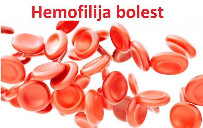 Hemofilija Bolest – Značenje, Uzrok, Simptomi I Lečenje